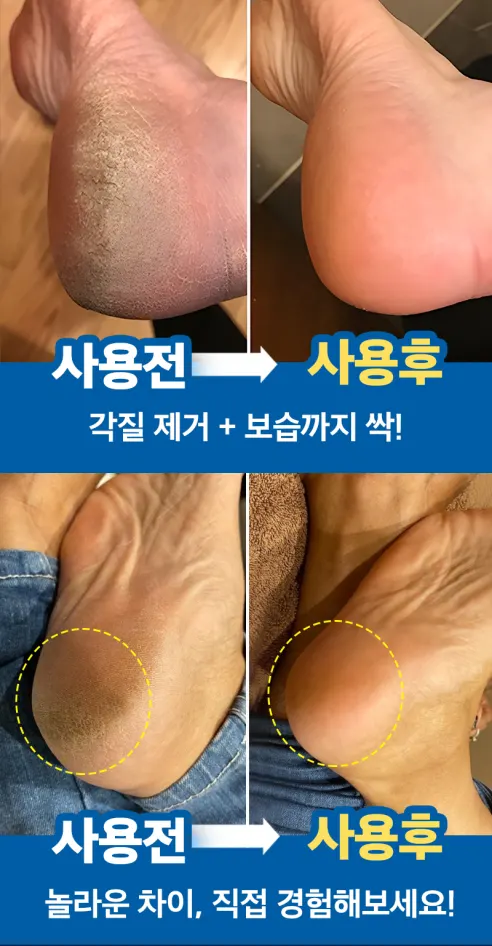 풋시톨 발각질 제거제 + 풋파일 1개 상세 이미지 5