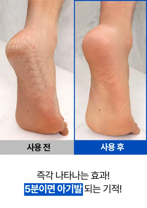 풋시톨 발각질 제거제 + 풋파일 1개 상세 이미지 14